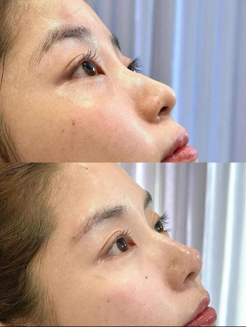 五、隆胸更换假体的其他常见疑问