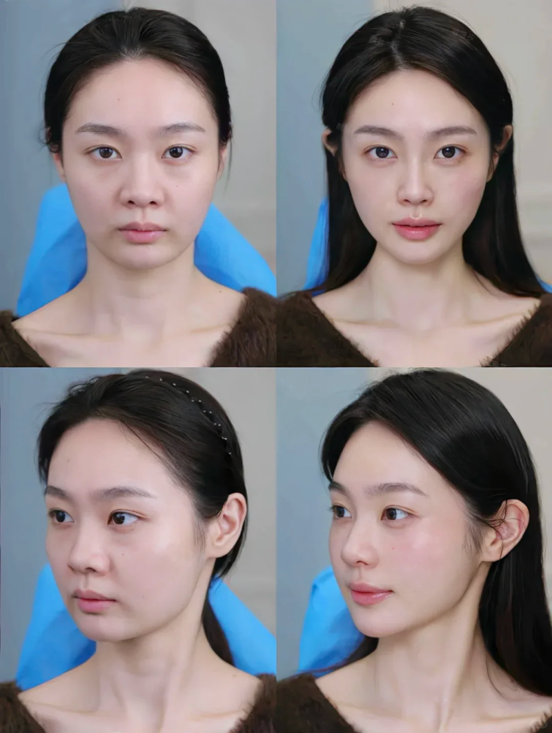 五、瘦脸针成效的维护与延长技巧