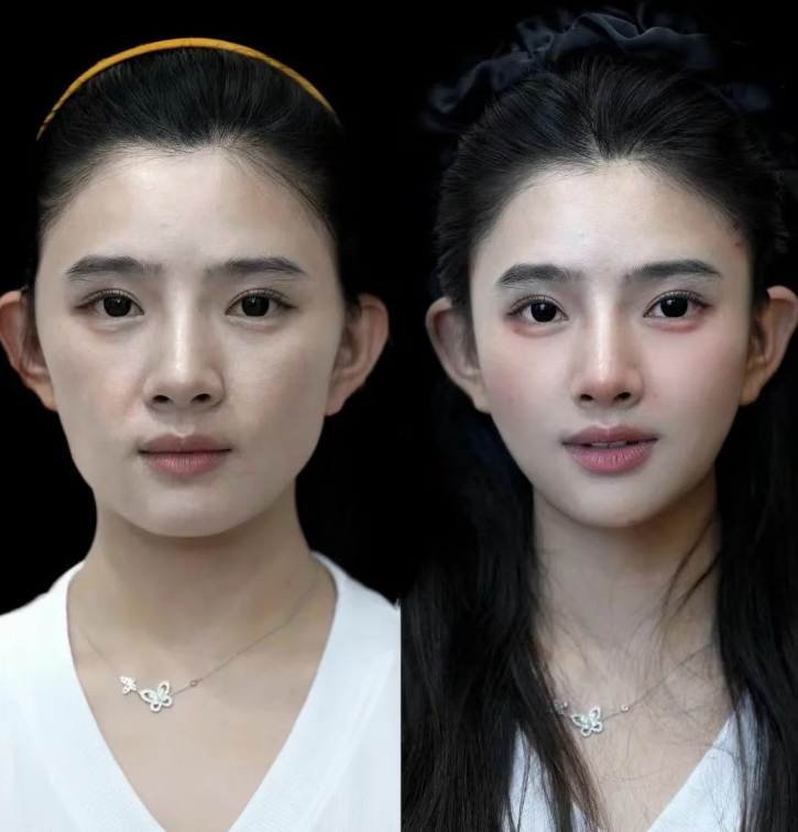 四、做完双眼皮眼睛会衰老吗?误区澄清与科学维护