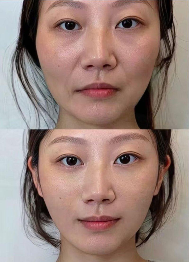 二、面部吸脂几年后老得更快的特殊情况解析