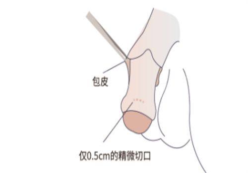 五、割双眼皮后能见风吗