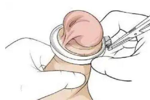 六、刮痧去眼袋的常见认知误区