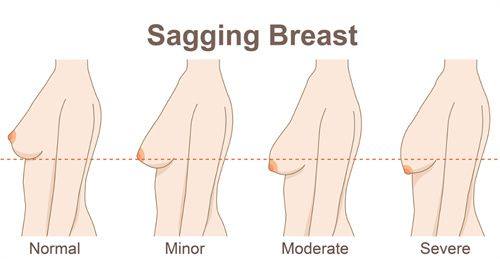 三、为什么有人觉得瘦脸针四个月就反弹了