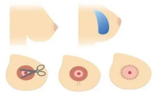 四、子宫疤痕修复手术一般多少钱