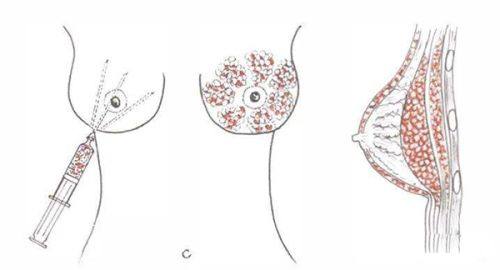 二、刮痧去眼袋的核心中医理论依据