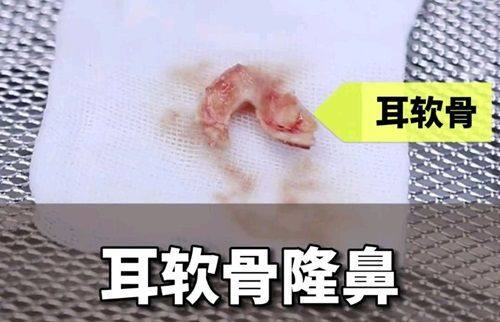 五、子宫疤痕修复手术后多久可以怀孕
