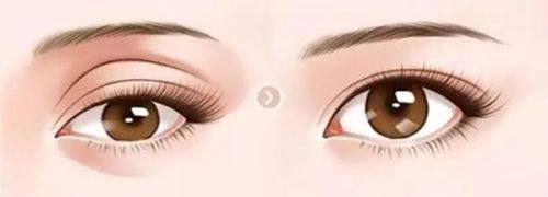 四、增生期选芭克还是舒痕？关键看这几点