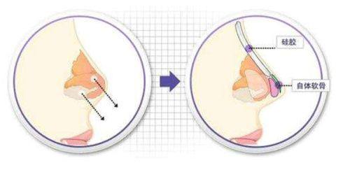 二、割完双眼皮见风了会留疤吗