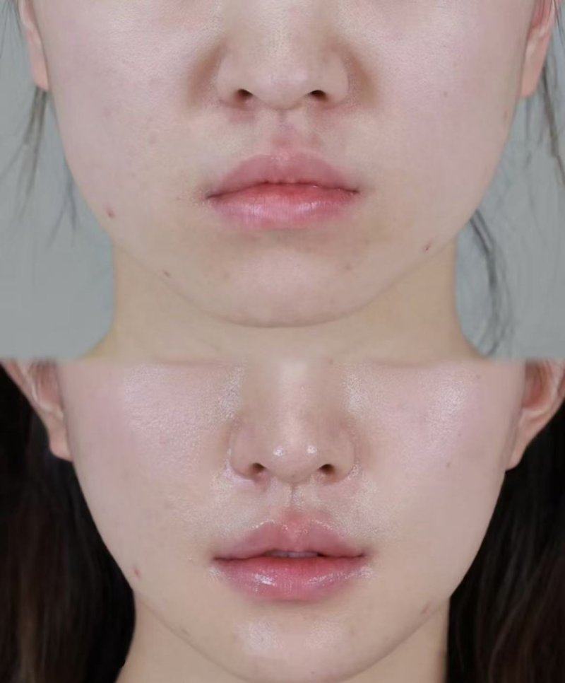 三、后脑勺疤痕疙瘩怎么消除