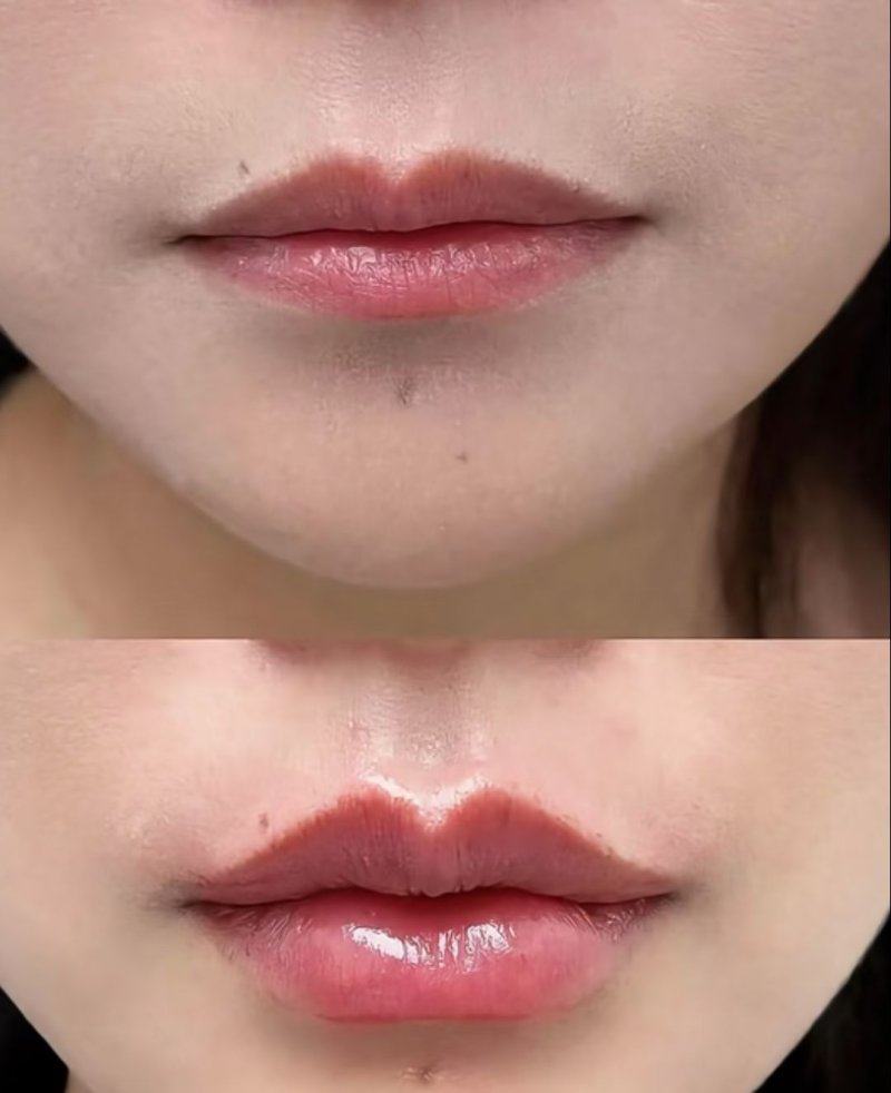 二、打瘦脸针四个月了还能回到以前么