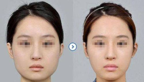 五、关于眼皮血管与双眼皮手术的常见误区澄清