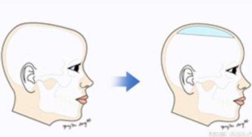 四、告别“消除眼袋眼细纹的按摩”执念，医美方案全解析