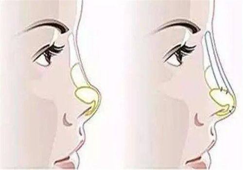 二、普通硅胶假体:遵循“10年评估、15年更换”原则