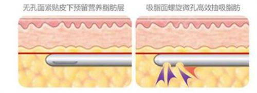 五、如何避开“眼袋眼皱纹怎么按摩消除视频教程”的坑，选择靠谱医美