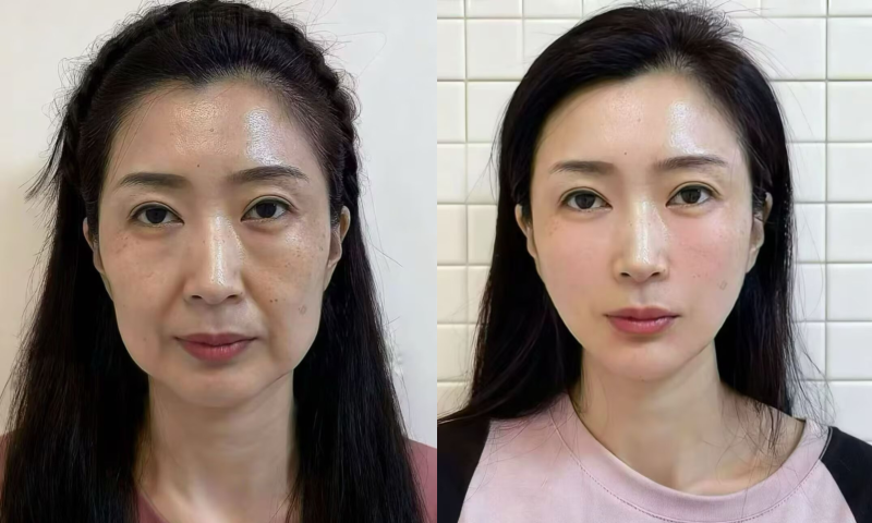 二、抽脂常见后遗症及诱发原因