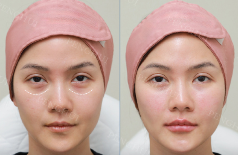 二、别被“消除眼纹眼袋的按摩手法”类视频误导