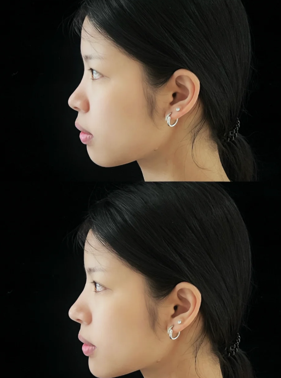 五、烧烫疤痕能治疗好吗?理性看待治疗目标