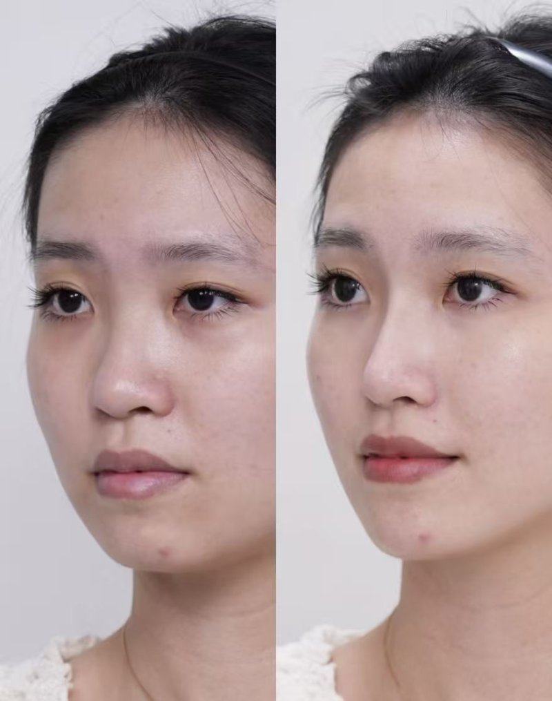 二、烫伤后疤痕痒硬了怎么办？用什么药缓解