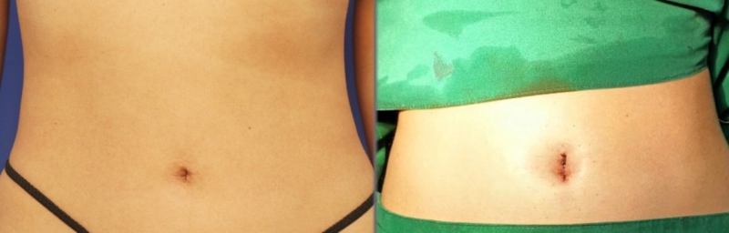 五、关于假体更换的关键误区澄清