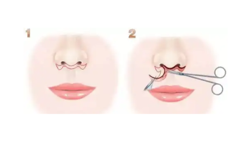 三、自体脂肪隆胸一般需要几次填充