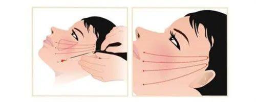 五、如何降低隆胸手术的风险与危害