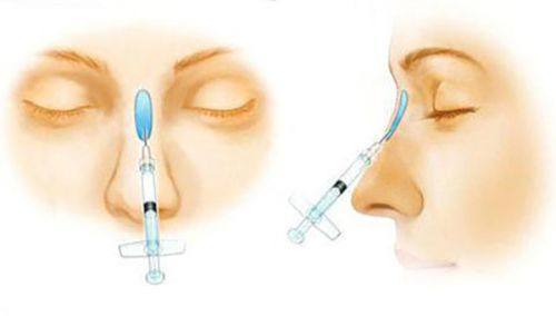 二、自体脂肪隆胸多久可以二次填充玻尿酸