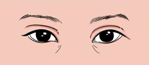 五、耳软骨隆鼻尖真实修复实例参考