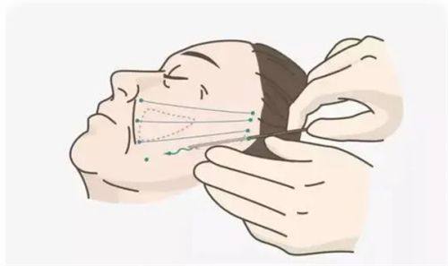 四、20岁有眼袋能修复吗？