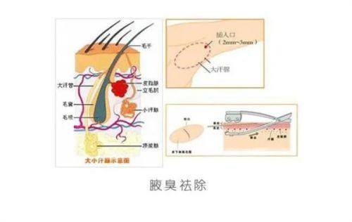 三、假体隆胸晃动感与胀气感的应对方法
