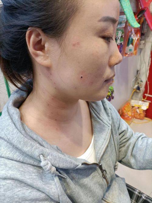 南充阆中阿蓝整形医院价格表：