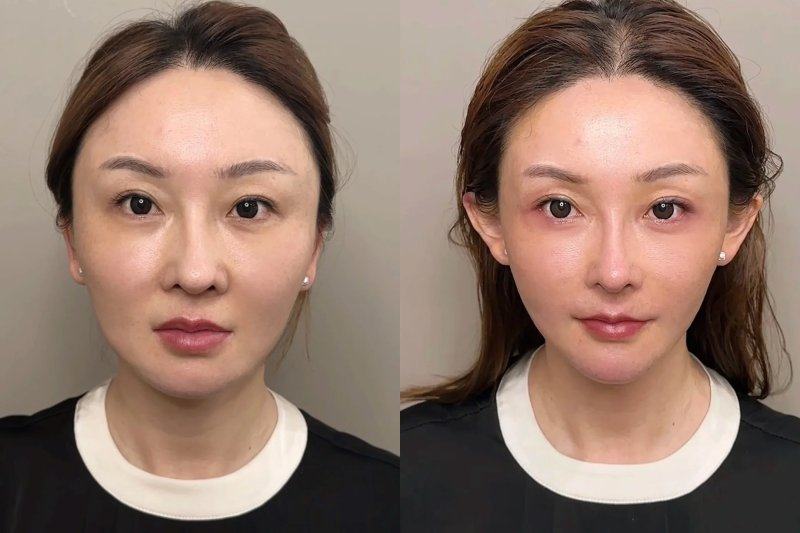 三、假体隆胸失败的概率相关说明