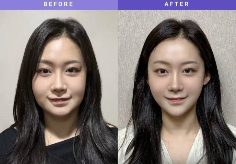 三、20岁有眼袋能去掉吗？