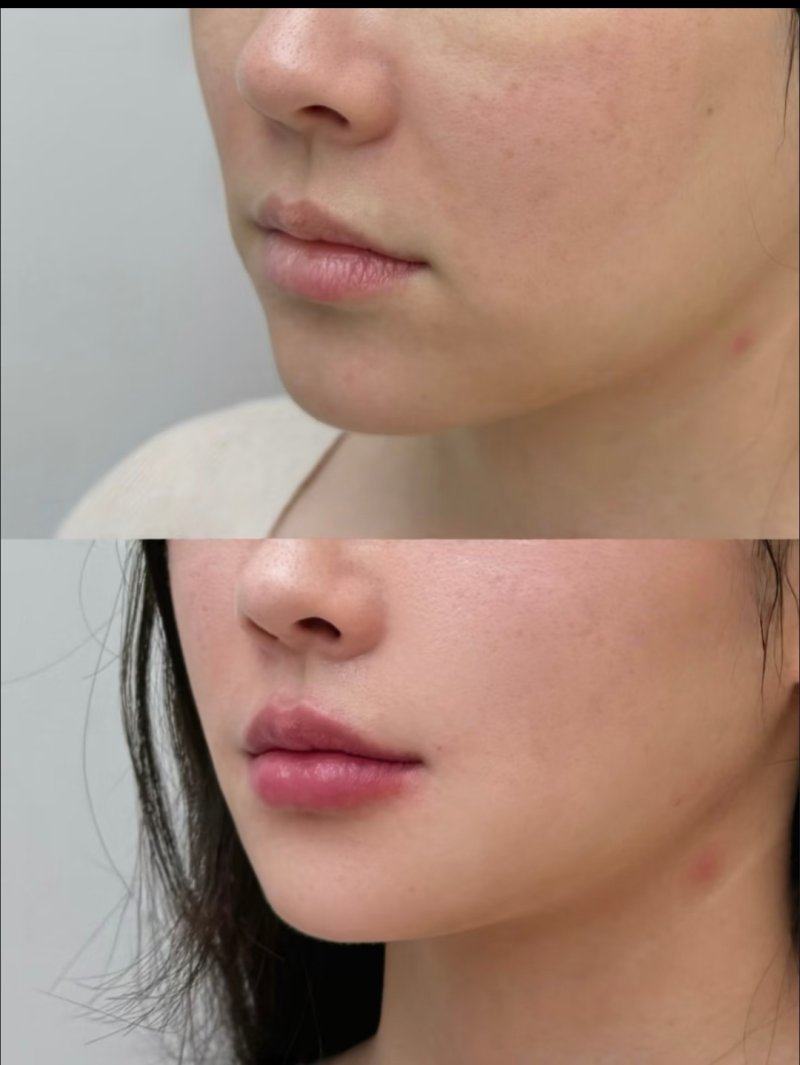 二、非手术类黑疤医疗改善方案