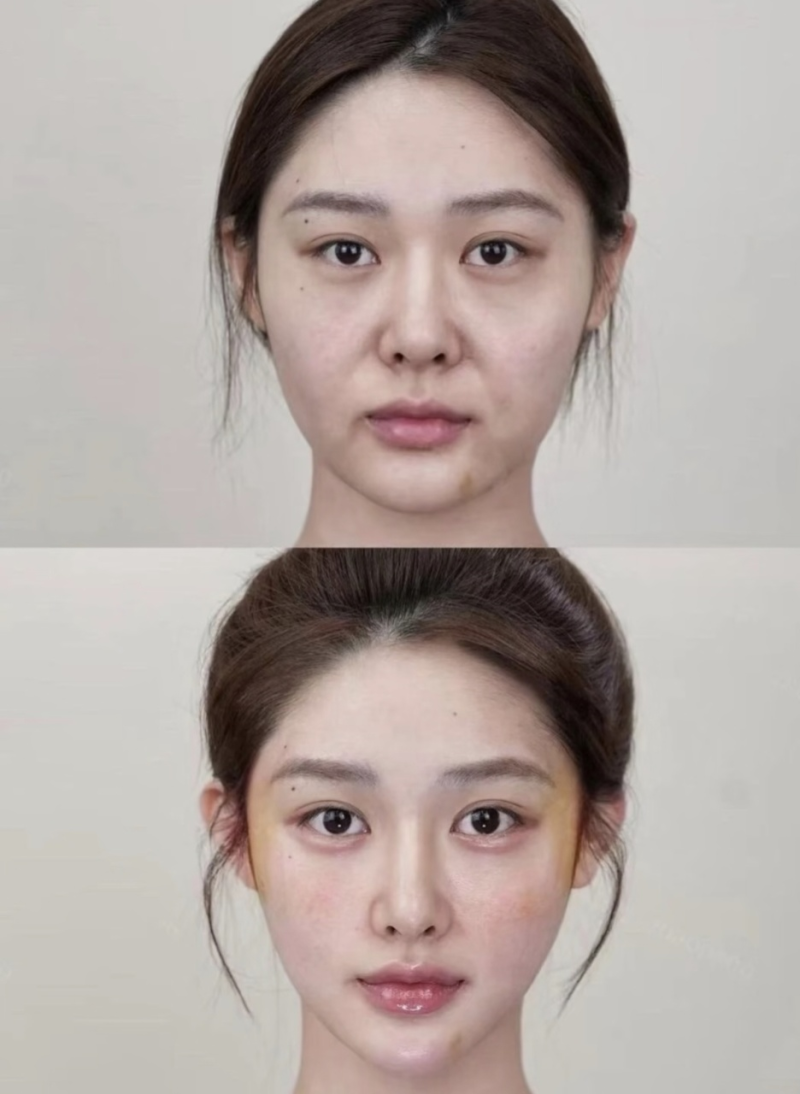 二、隆胸手术的后遗症有哪些