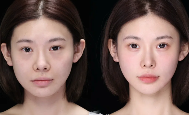 五、假体隆胸修复前后的关键注意事项