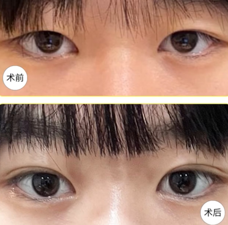 三、手术类黑疤医疗修复方案