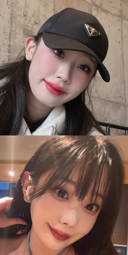 四、耳软骨隆鼻鼻头多久会变小消肿