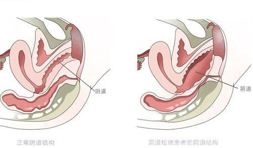 五、全切双眼皮:全方面改善眼型的恒久之选