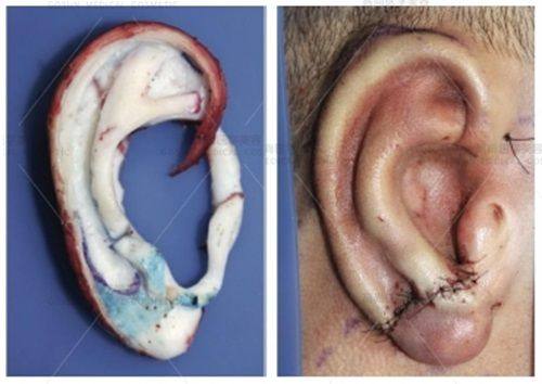 四、传统疗法的局限性：为什么不建议单独用于长疤痕疙瘩