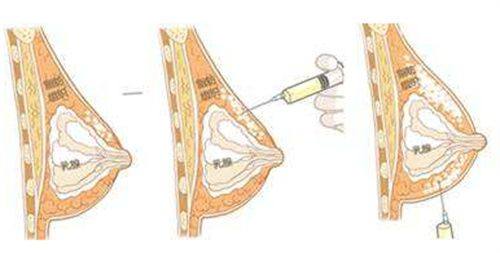 二、日常护理去眼袋:适合水肿型、轻度眼袋,长期坚持见成效