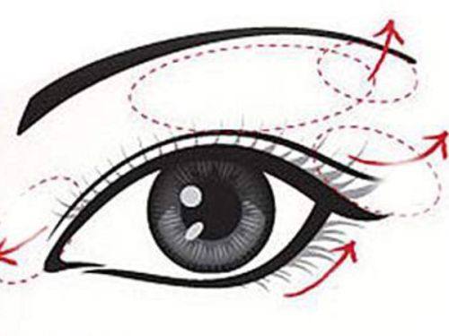 四、高端假体也存在的潜在隐患