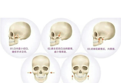 三、延长耳软骨隆鼻成效的护理要点