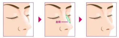 三、浅表凹坑/轻微凹陷：特定去疤膏能帮你改善外观