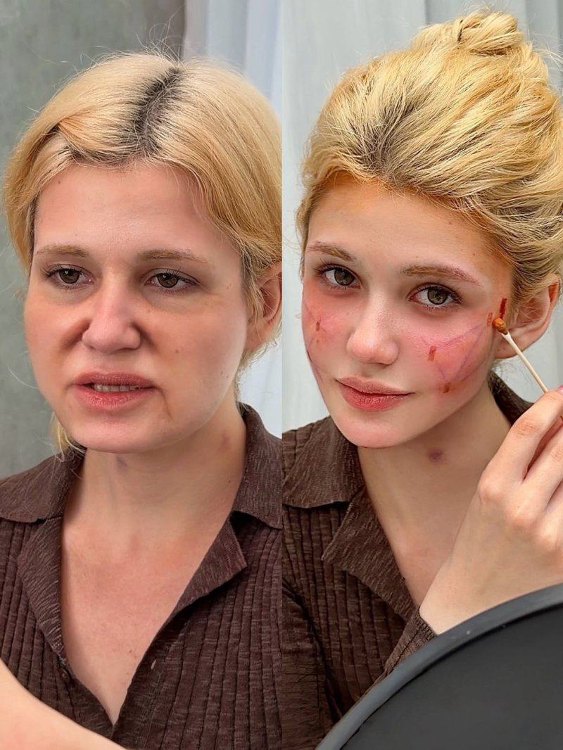 四、陈旧性深凹陷疤痕：别依赖去疤膏，需专精医美干预