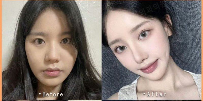 二、长疤痕疙瘩的临床实效：从实例看SRT-100的蜕变力量