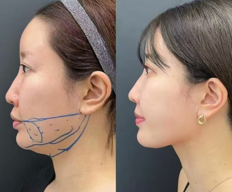 三、微创埋线法:适合年轻群体的自然双眼皮