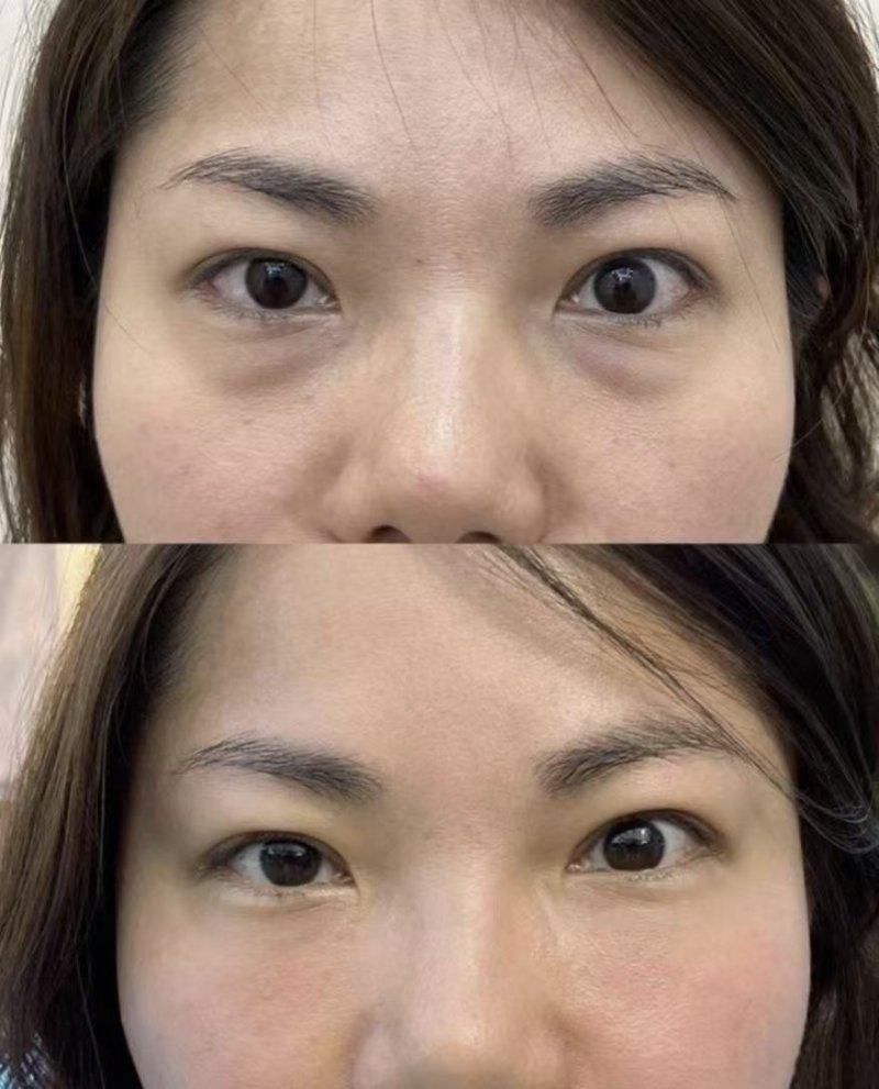 四、耳软骨隆鼻术后修复与就医建议