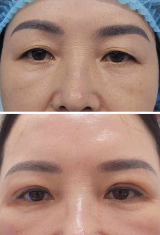 三、除了出血，感染与并发症风险更要警惕