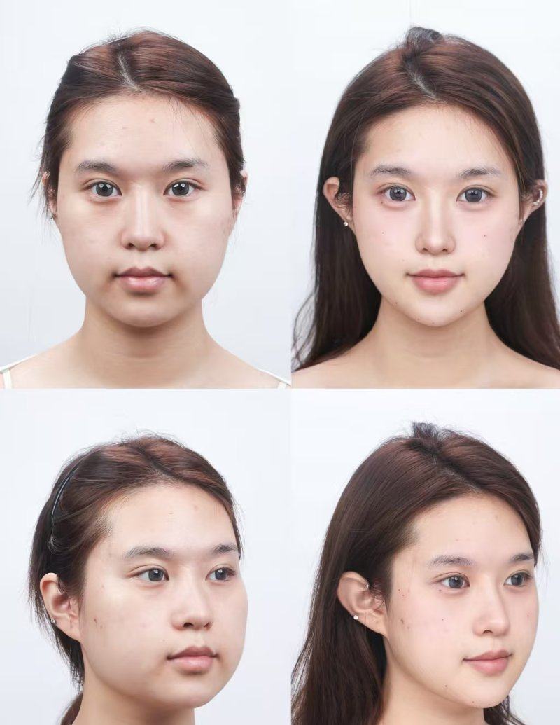 六、耳软骨隆鼻成效维持与吸收时长