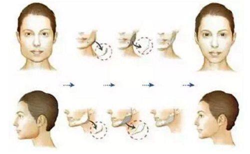 四、双眼皮手术副作用大吗?关键在“可控”二字